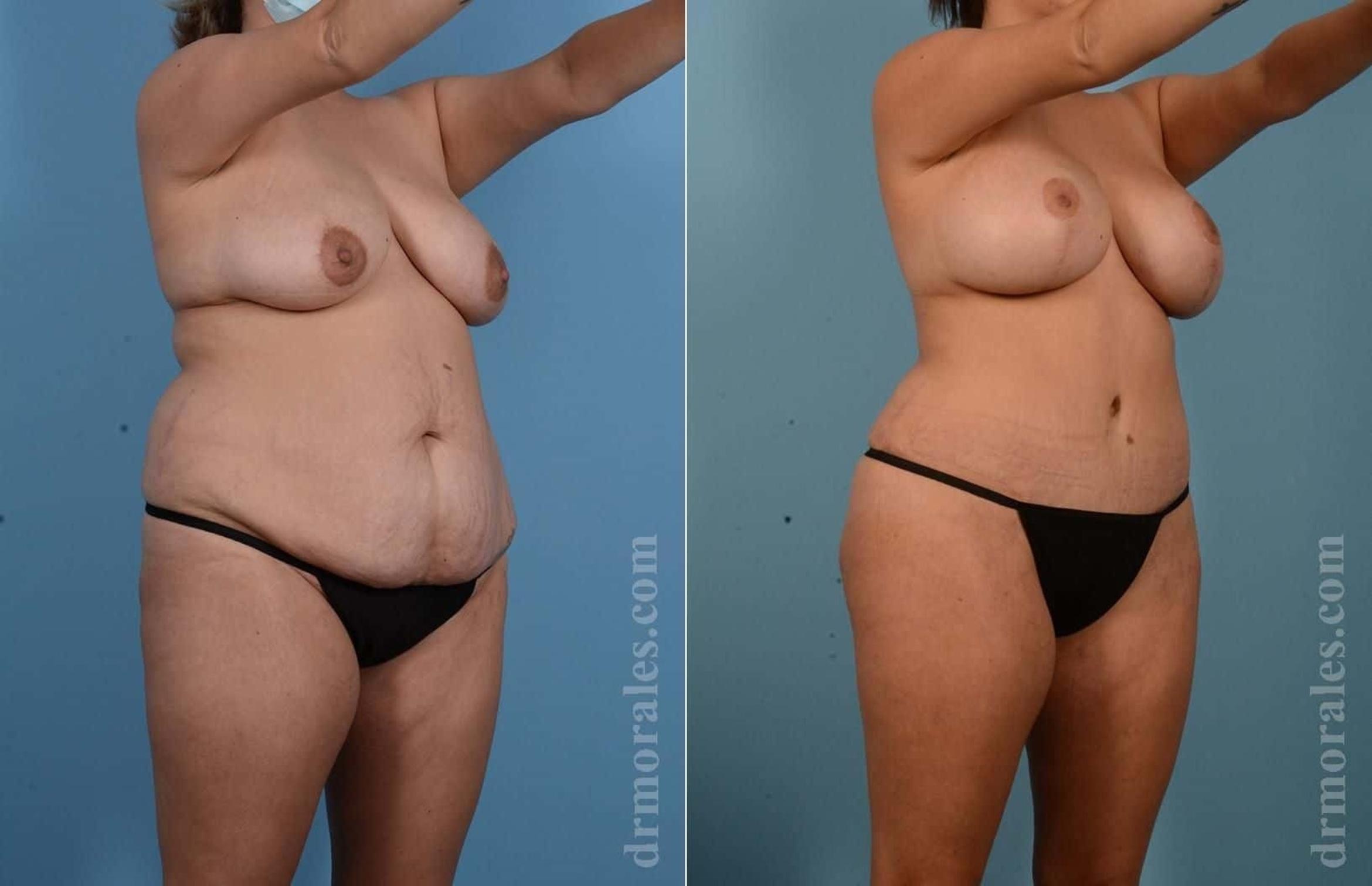 Before & After Mommy Makeover Case 61 View 1 View in Houston, TX