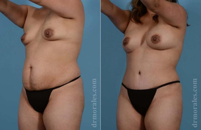 Before & After Mommy Makeover Case 62 View 1 View in Houston, TX