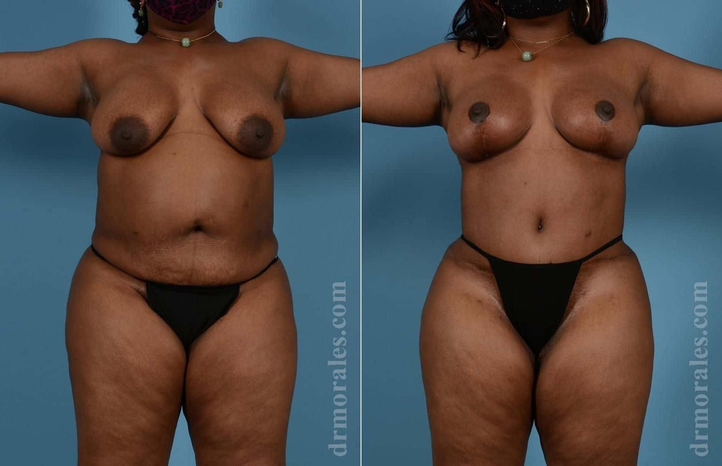 Before & After Mommy Makeover Case 63 View 1 View in Houston, TX