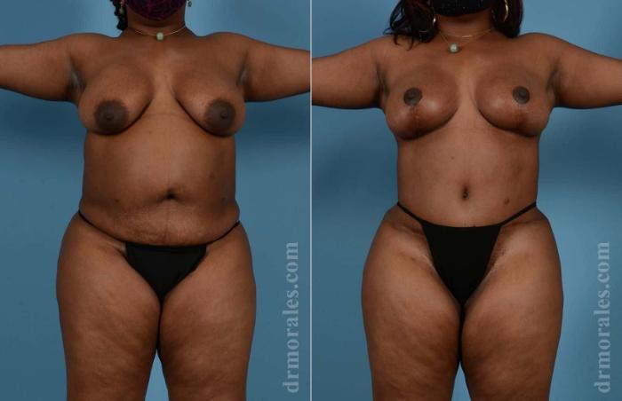 Before & After Mommy Makeover Case 63 View 1 View in Houston, TX