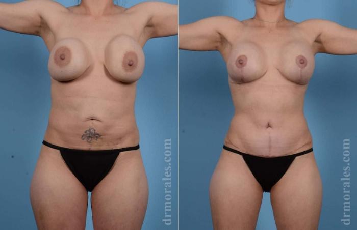 Before & After Mommy Makeover Case 64 View 1 View in Houston, TX