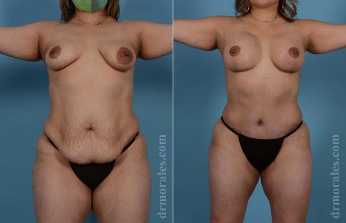 Before & After Mommy Makeover Case 65 View 1 View in Houston, TX