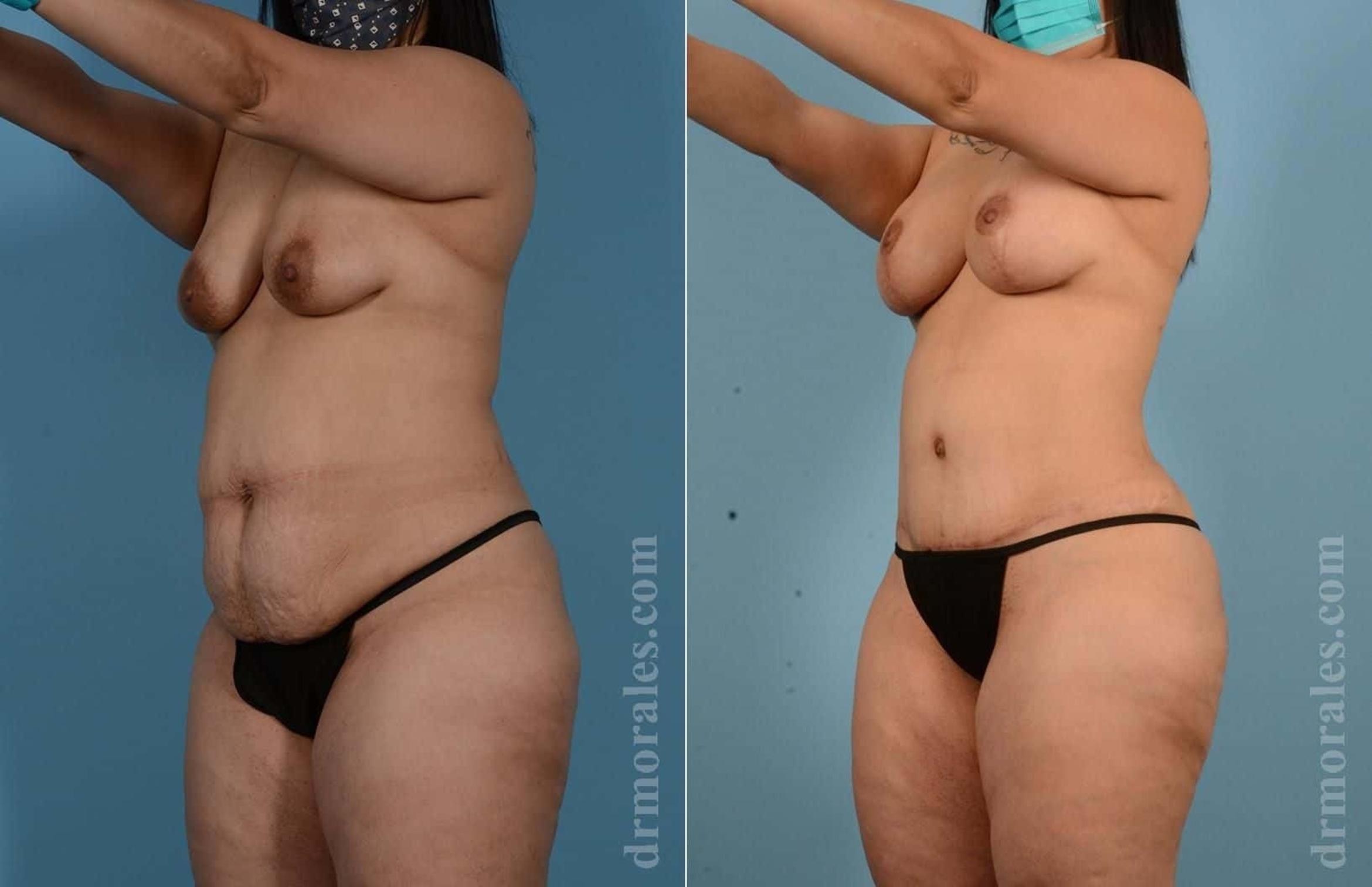 Before & After Mommy Makeover Case 66 View 1 View in Houston, TX