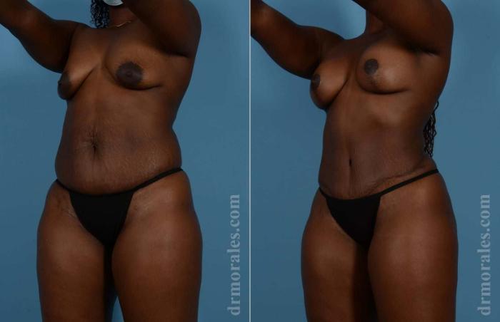 Before & After Mommy Makeover Case 67 View 1 View in Houston, TX