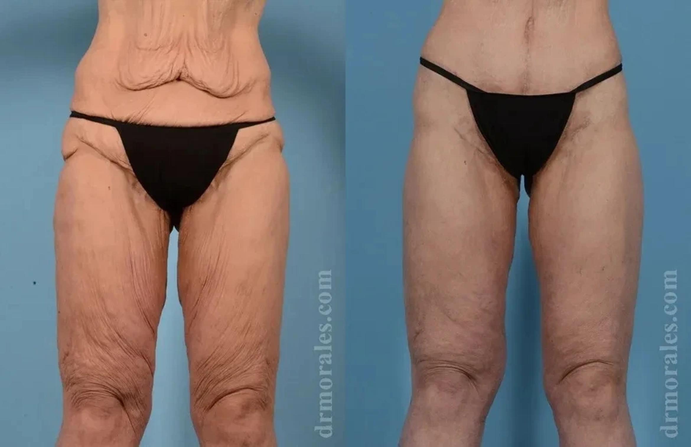 Before & After Thigh Lift Case 191 View 1 View in Houston, TX