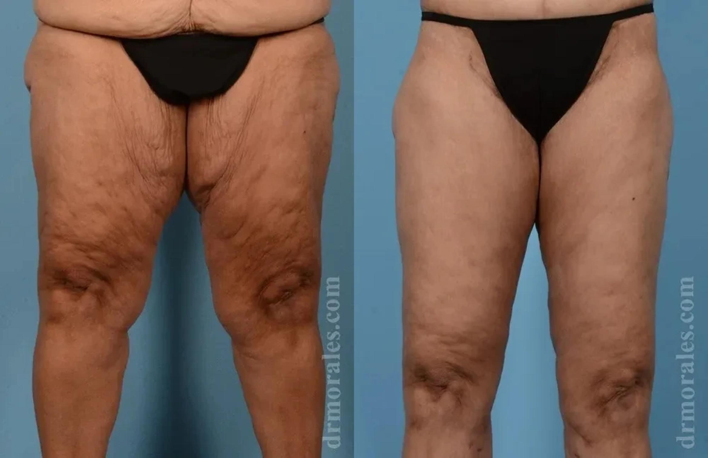 Before & After Thigh Lift Case 192 View 1 View in Houston, TX