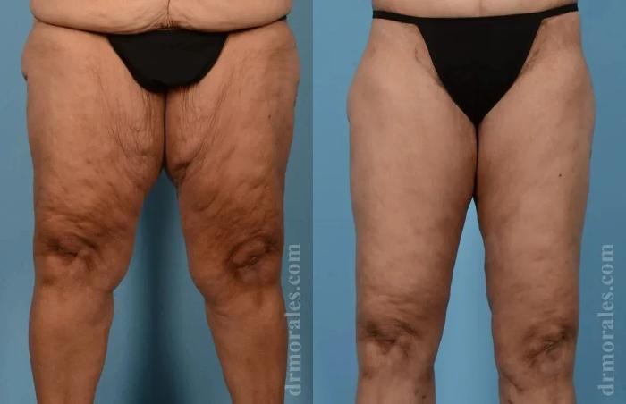 Before & After Thigh Lift Case 192 View 1 View in Houston, TX