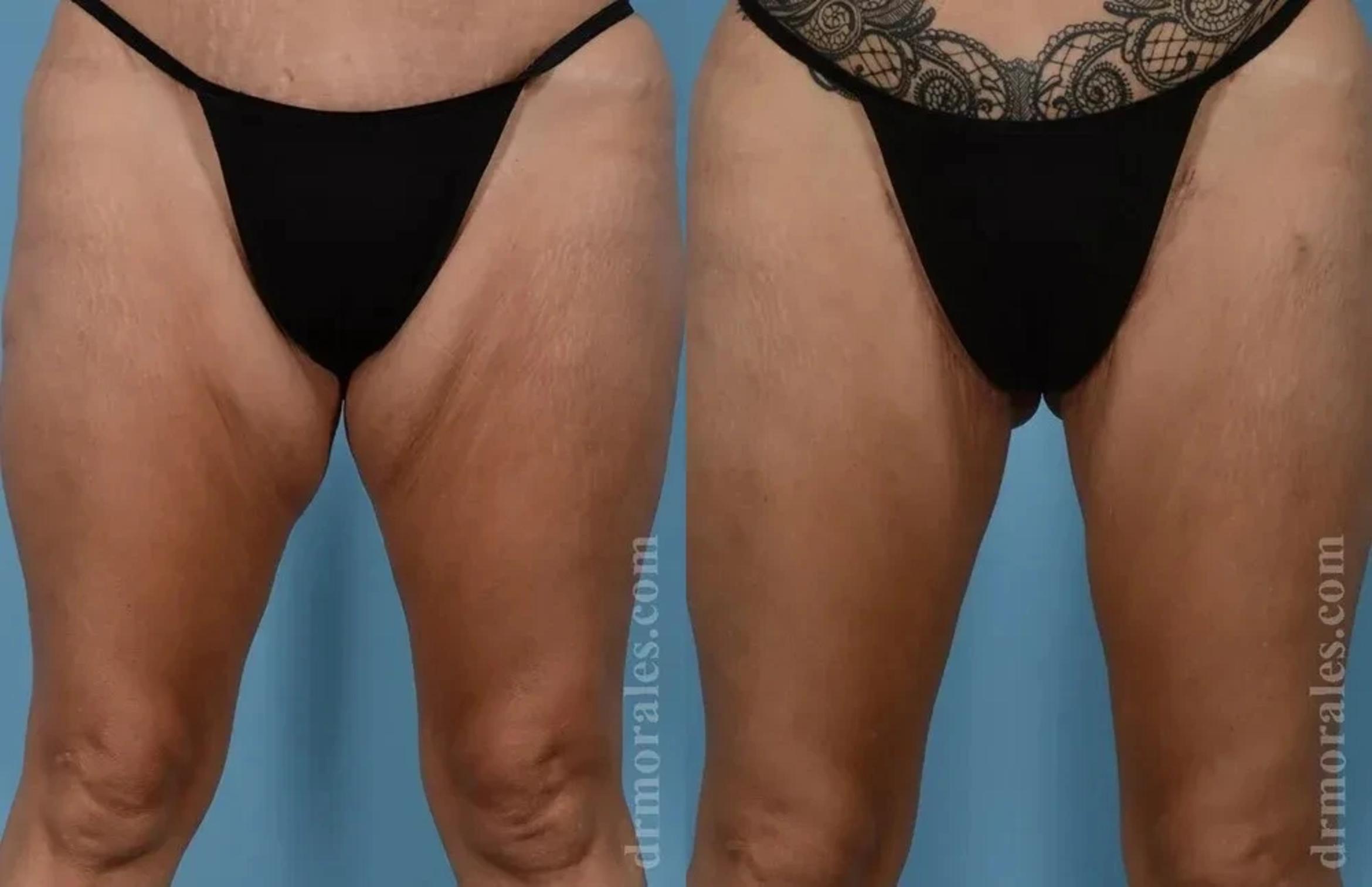 Before & After Thigh Lift Case 193 View 1 View in Houston, TX