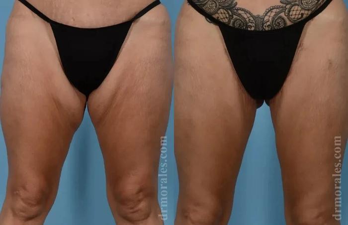 Before & After Thigh Lift Case 193 View 1 View in Houston, TX