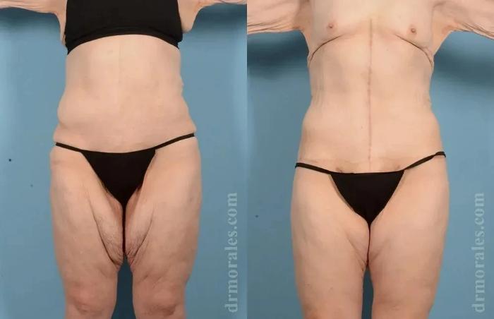 Before & After Thigh Lift Case 194 View 1 View in Houston, TX