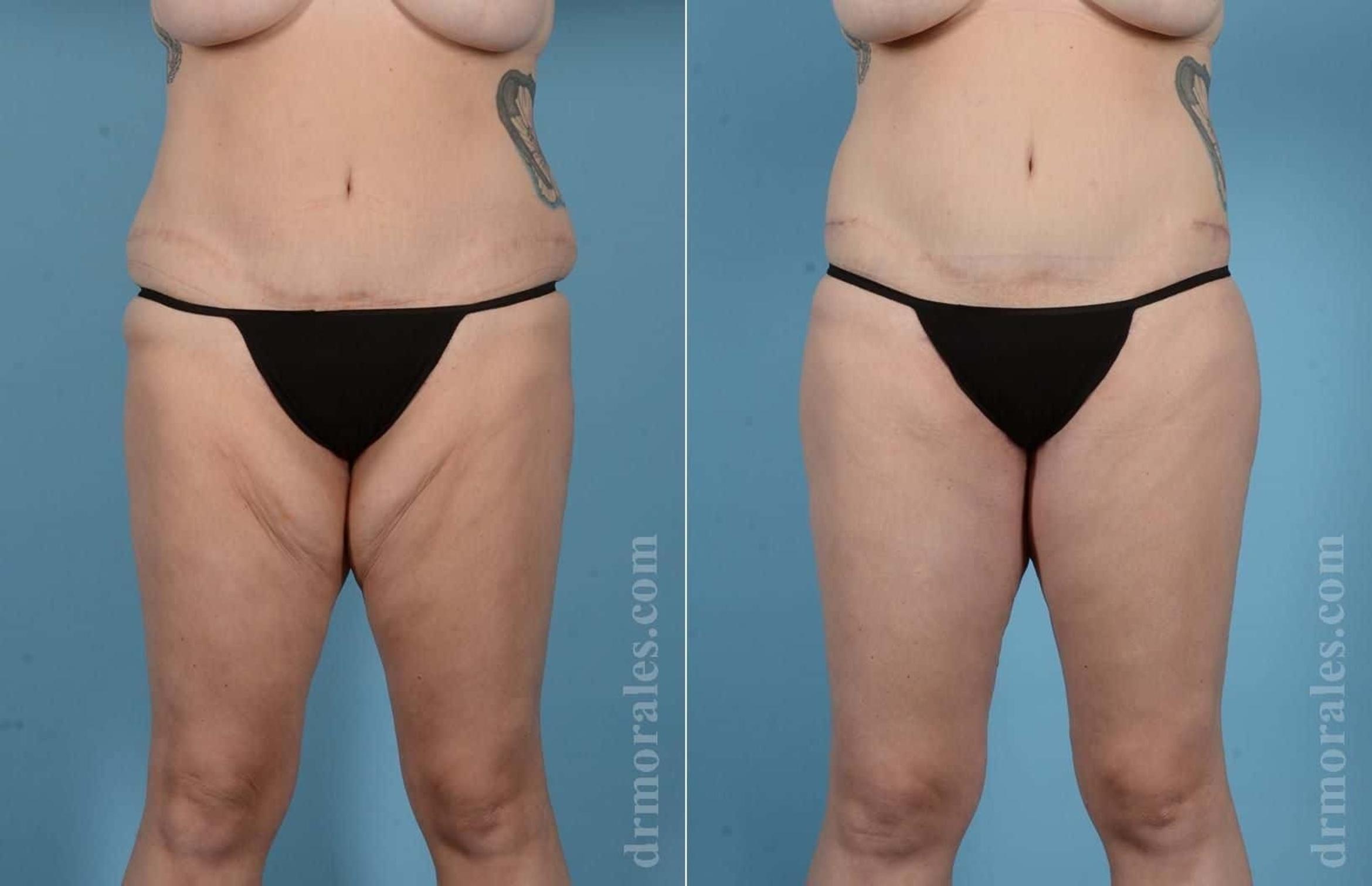 Before & After Thigh Lift Case 71 View 1 View in Houston, TX