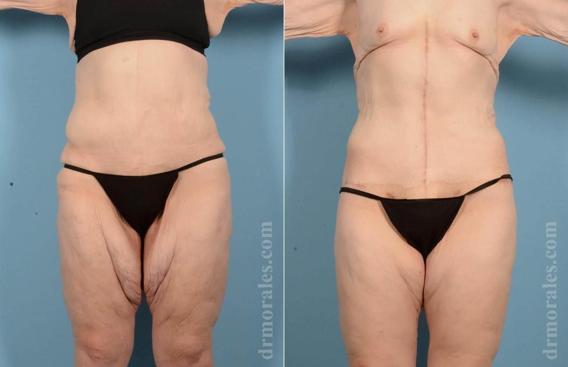 Before & After Thigh Lift Case 72 View 1 View in Houston, TX
