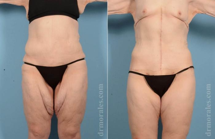 Before & After Thigh Lift Case 72 View 1 View in Houston, TX