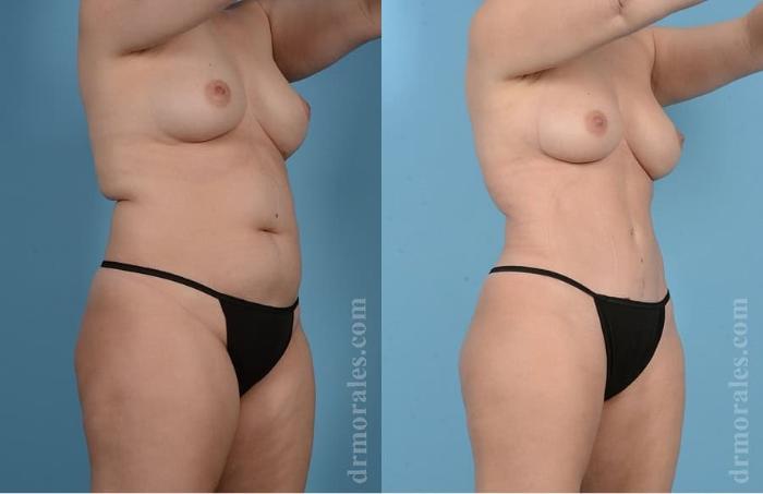 Before & After Tummy Tuck Case 28 View 1 View in Houston, TX