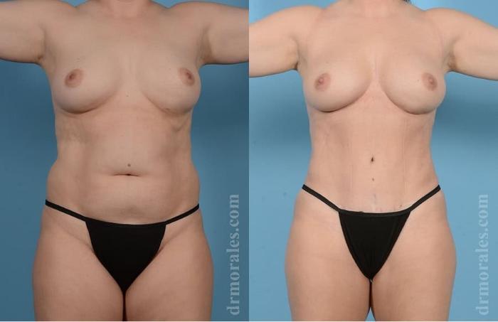 Before & After Tummy Tuck Case 29 View 1 View in Houston, TX