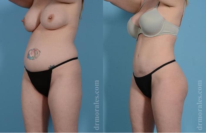 Before & After Tummy Tuck Case 30 View 1 View in Houston, TX