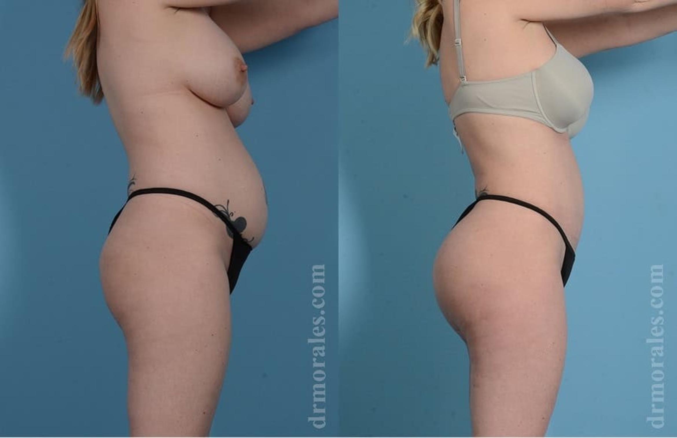 Before & After Tummy Tuck Case 31 View 1 View in Houston, TX