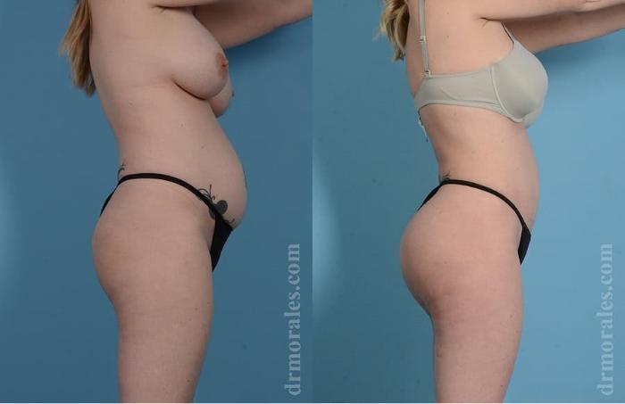 Before & After Tummy Tuck Case 31 View 1 View in Houston, TX