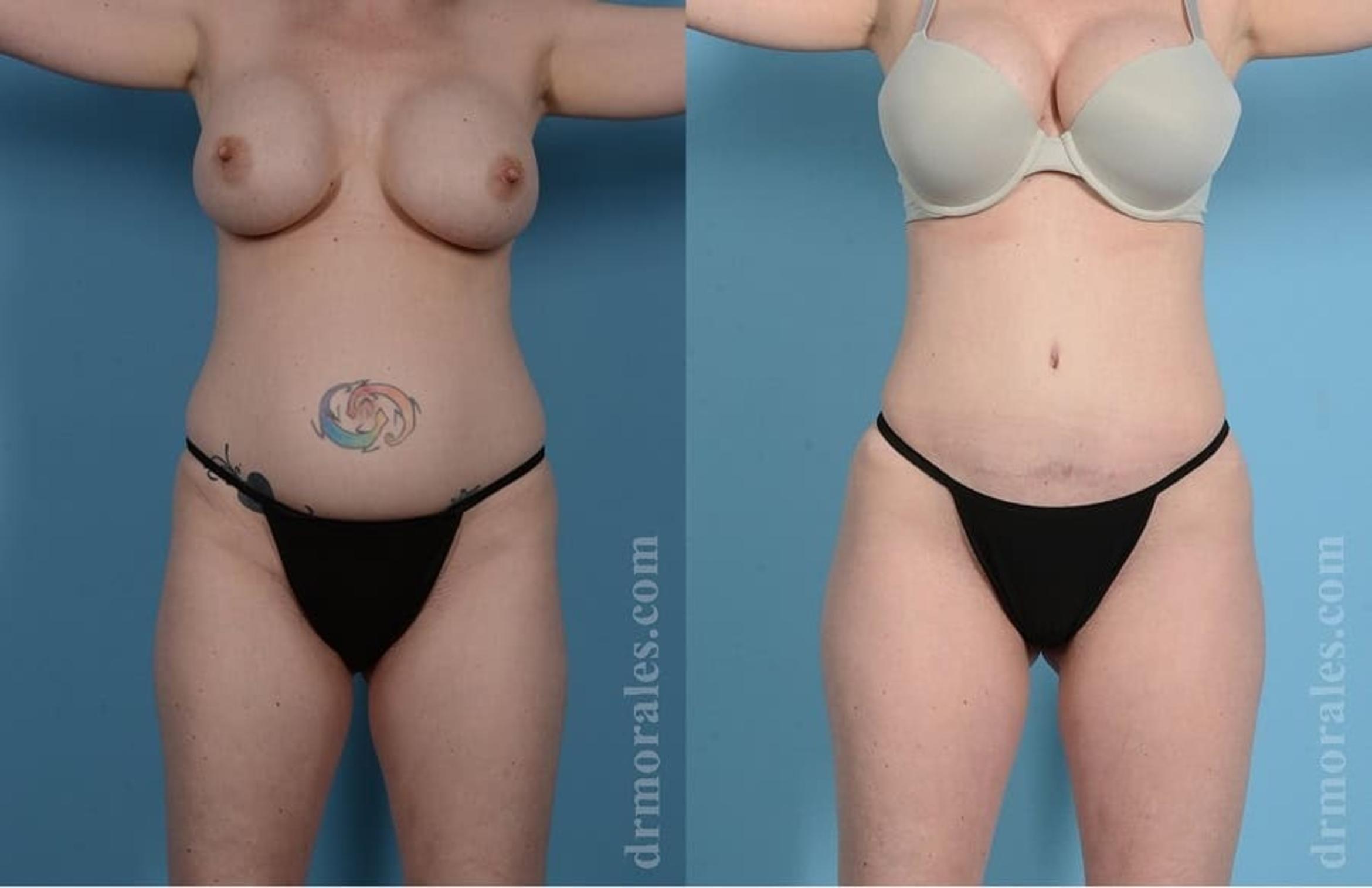 Before & After Tummy Tuck Case 32 View 1 View in Houston, TX