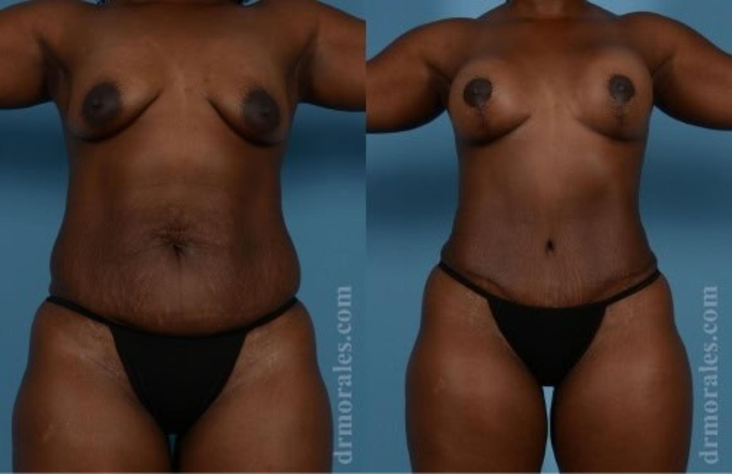 Before & After Tummy Tuck Case 464 View 1 View in Houston, TX