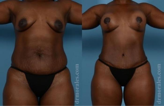 Before & After Tummy Tuck Case 464 View 1 View in Houston, TX