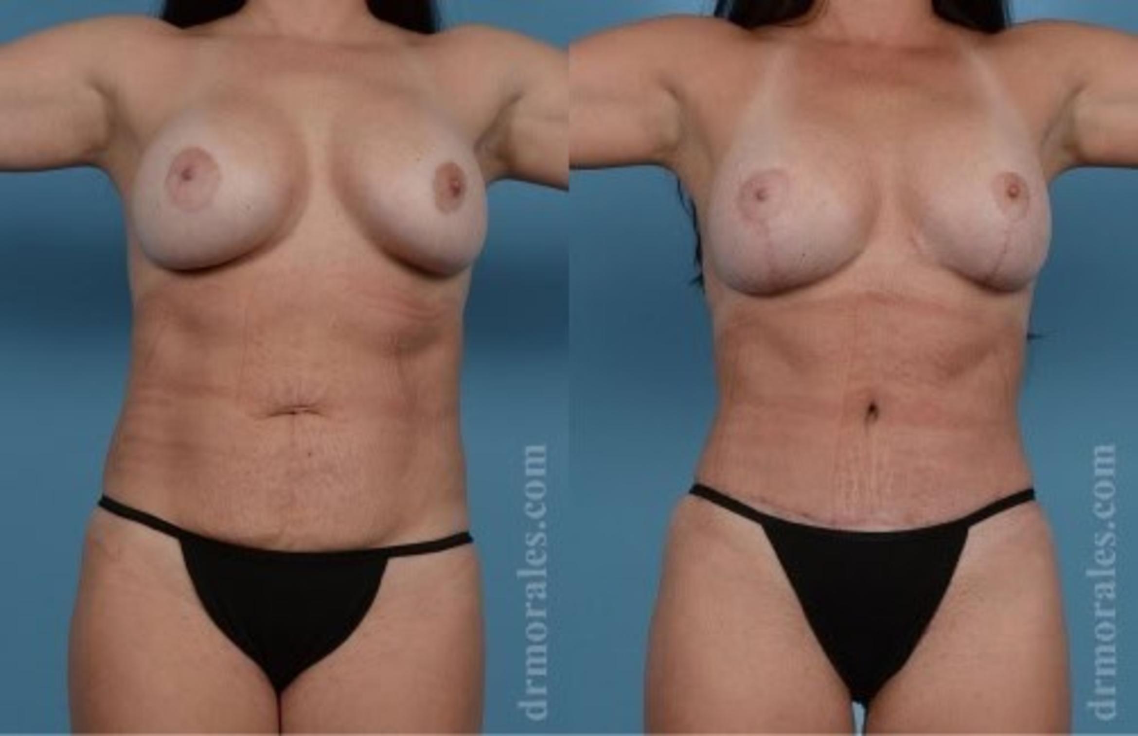 Before & After Tummy Tuck Case 465 View 1 View in Houston, TX