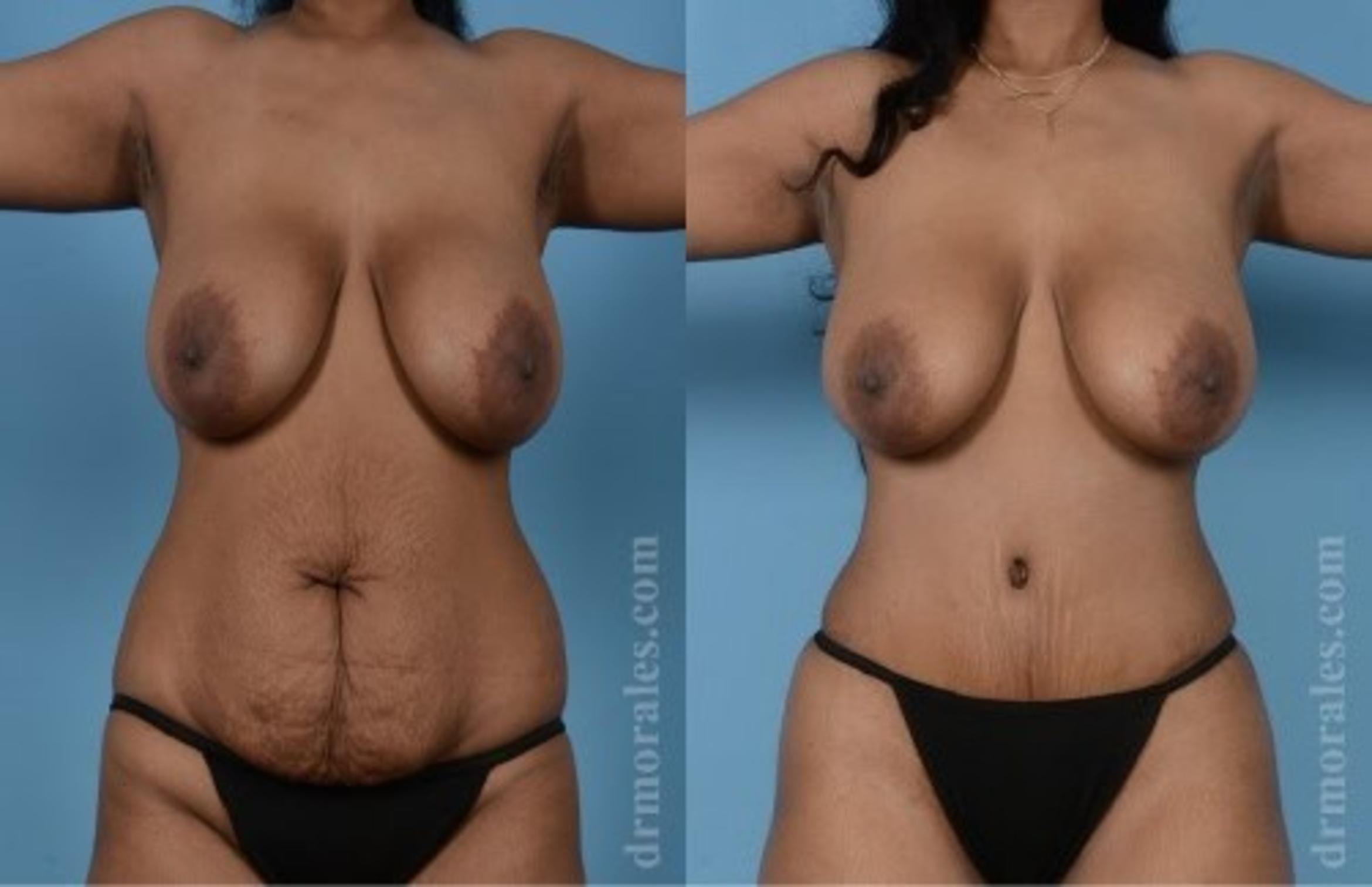 Before & After Tummy Tuck Case 466 View 1 View in Houston, TX