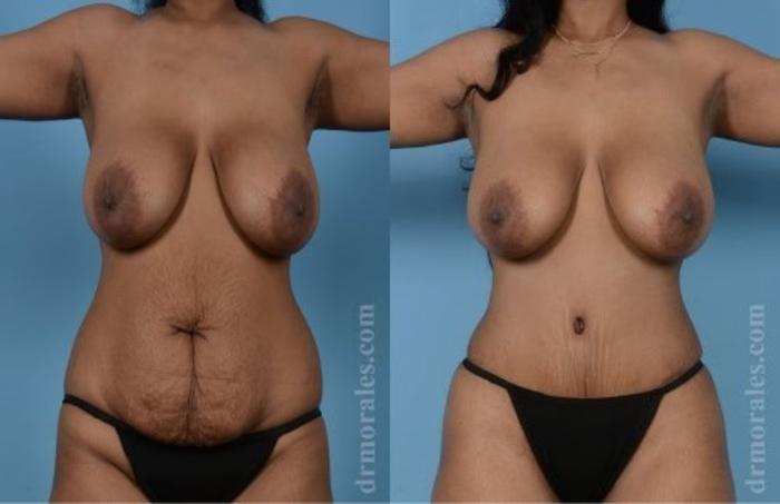 Before & After Tummy Tuck Case 466 View 1 View in Houston, TX