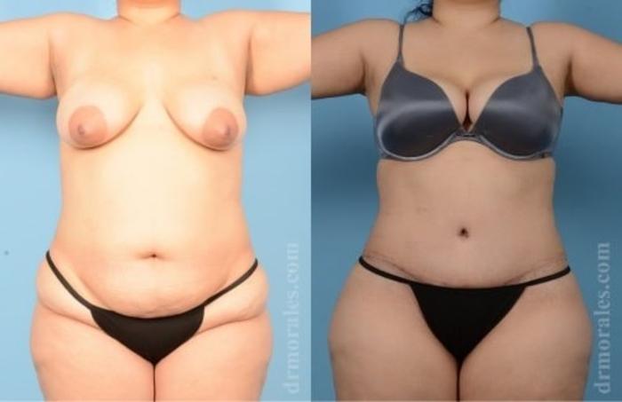 Before & After Tummy Tuck Case 468 View 1 View in Houston, TX
