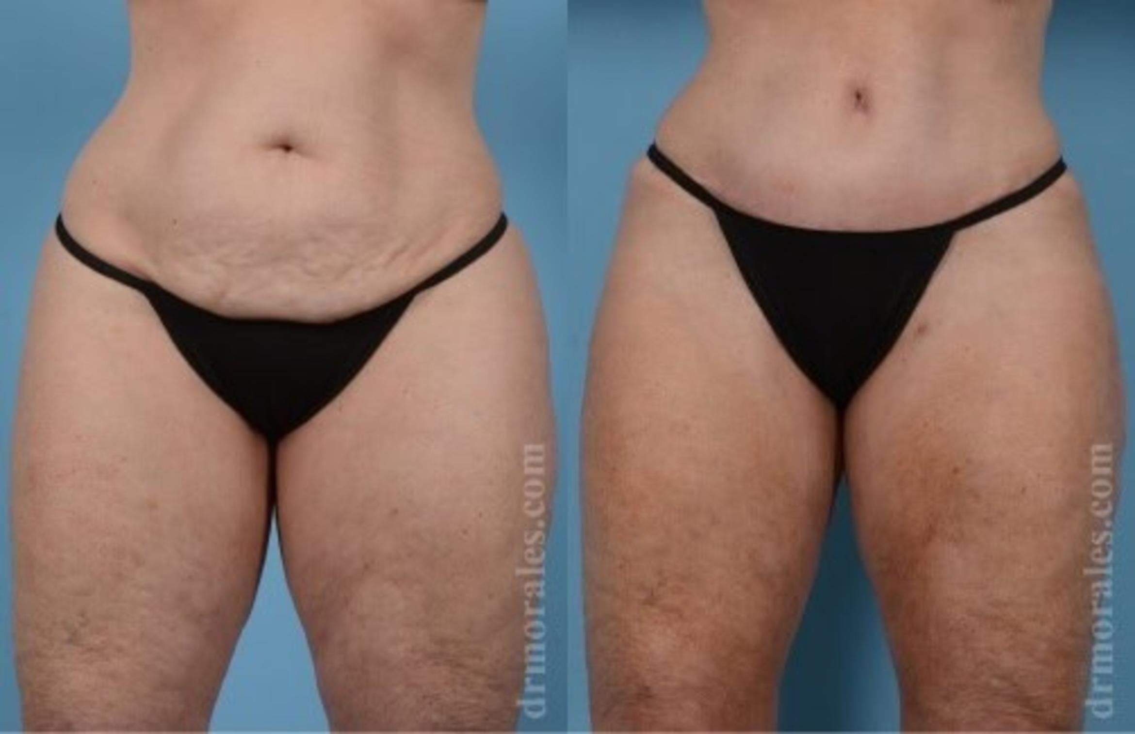Before & After Tummy Tuck Case 469 View 1 View in Houston, TX