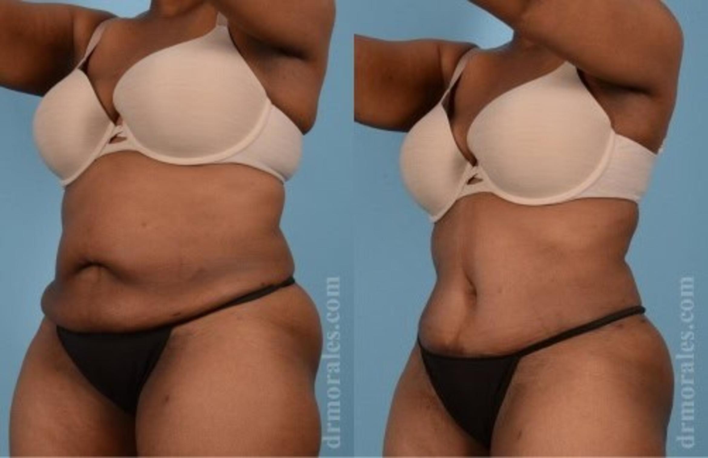 Before & After Tummy Tuck Case 470 View 1 View in Houston, TX