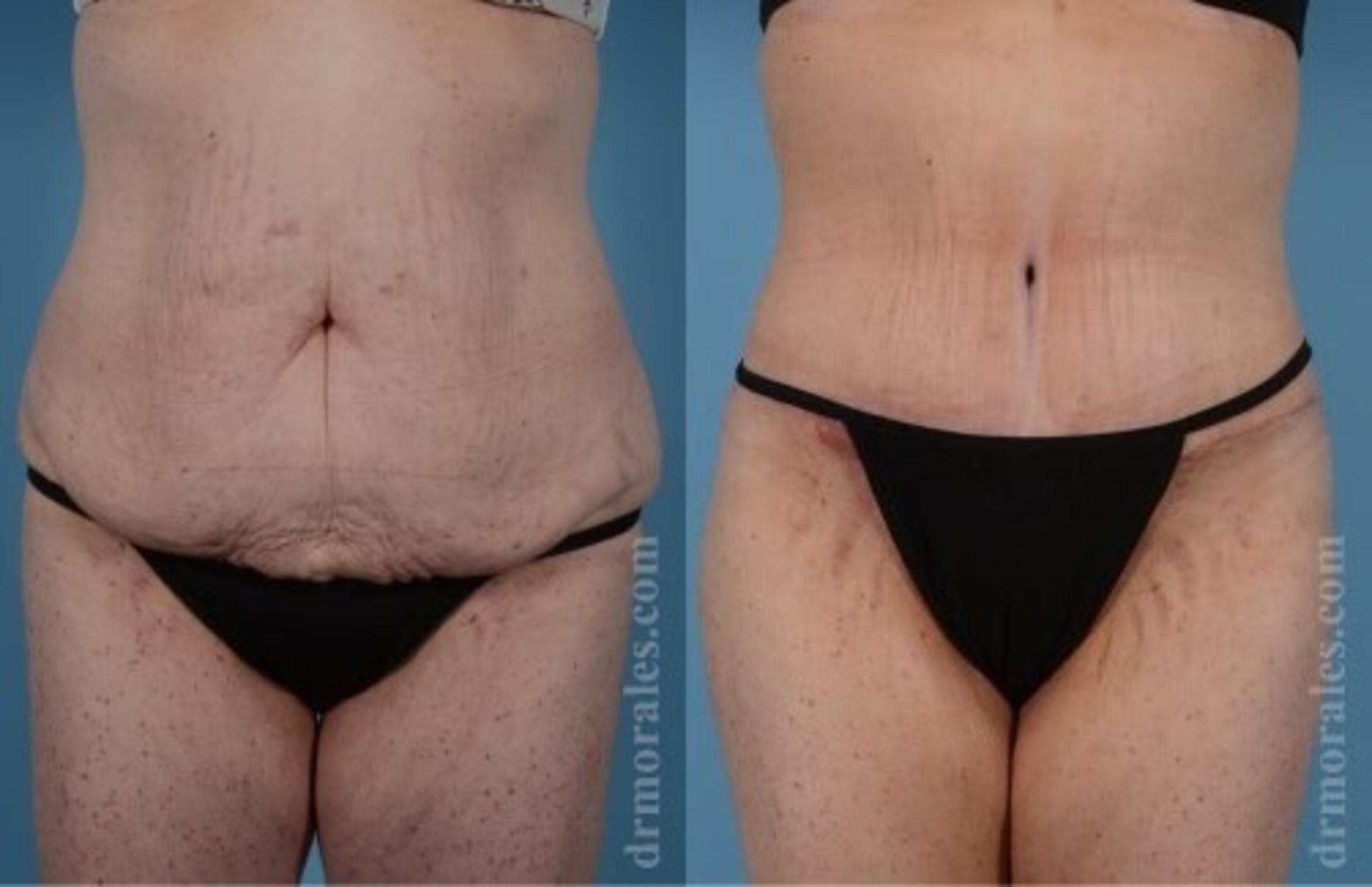 Before & After Tummy Tuck Case 471 View 1 View in Houston, TX