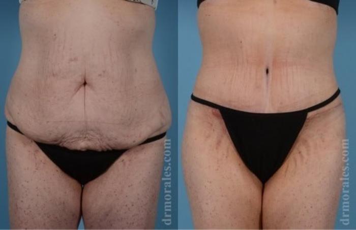 Before & After Tummy Tuck Case 471 View 1 View in Houston, TX