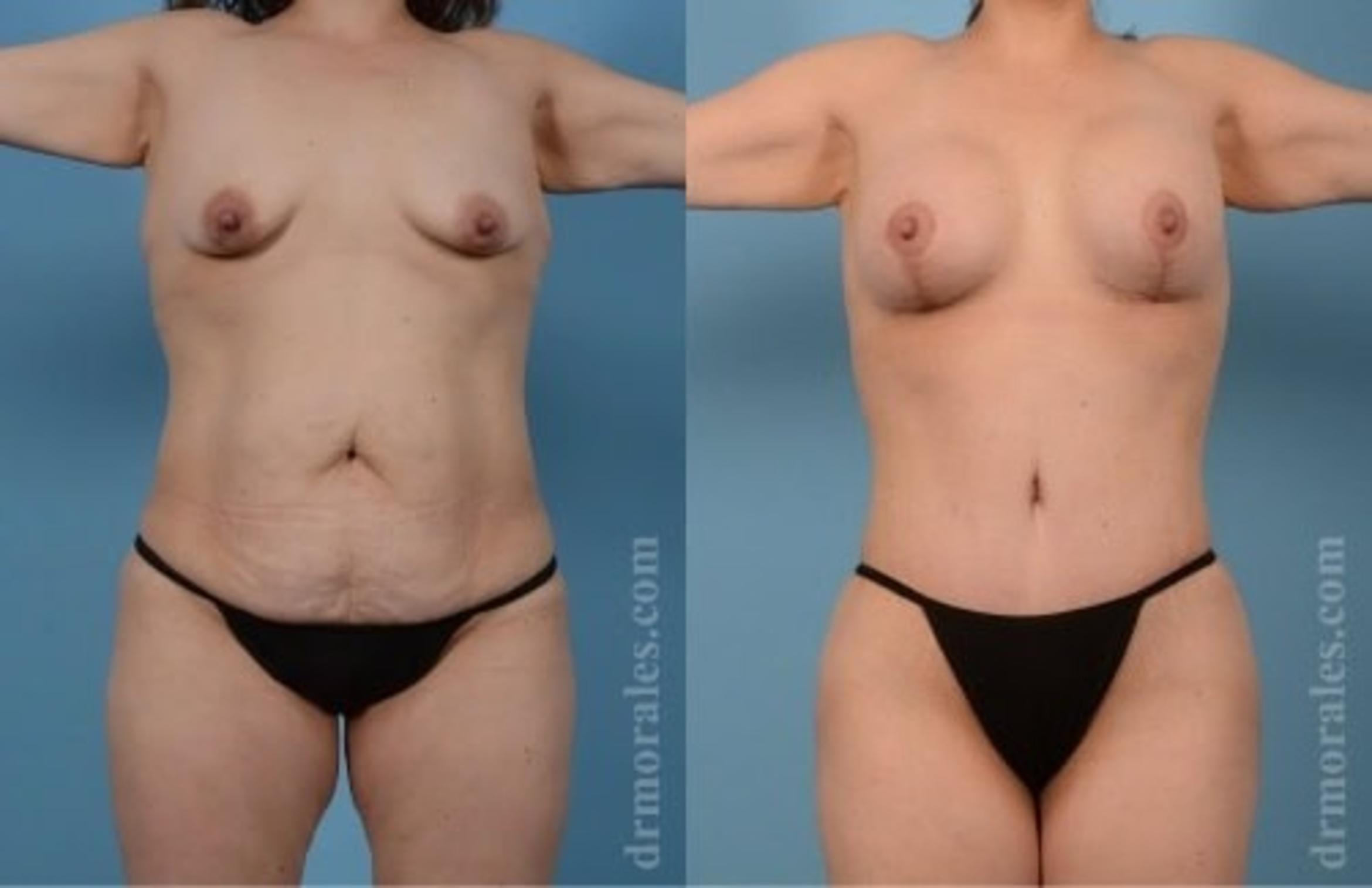 Before & After Tummy Tuck Case 472 View 1 View in Houston, TX