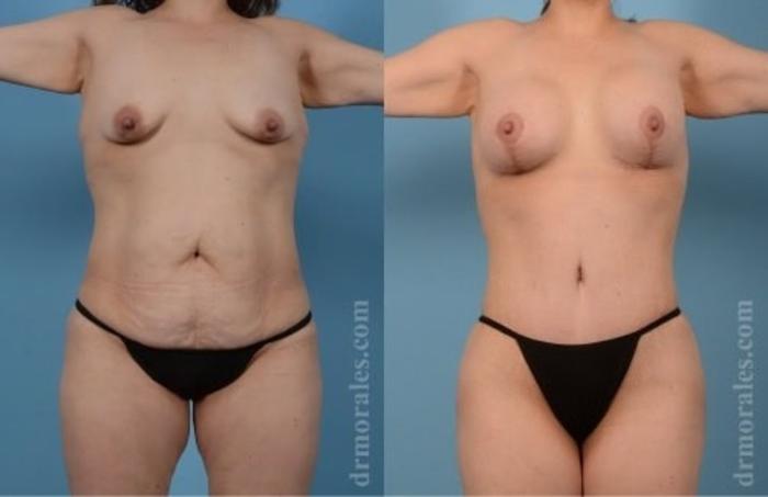 Before & After Tummy Tuck Case 472 View 1 View in Houston, TX