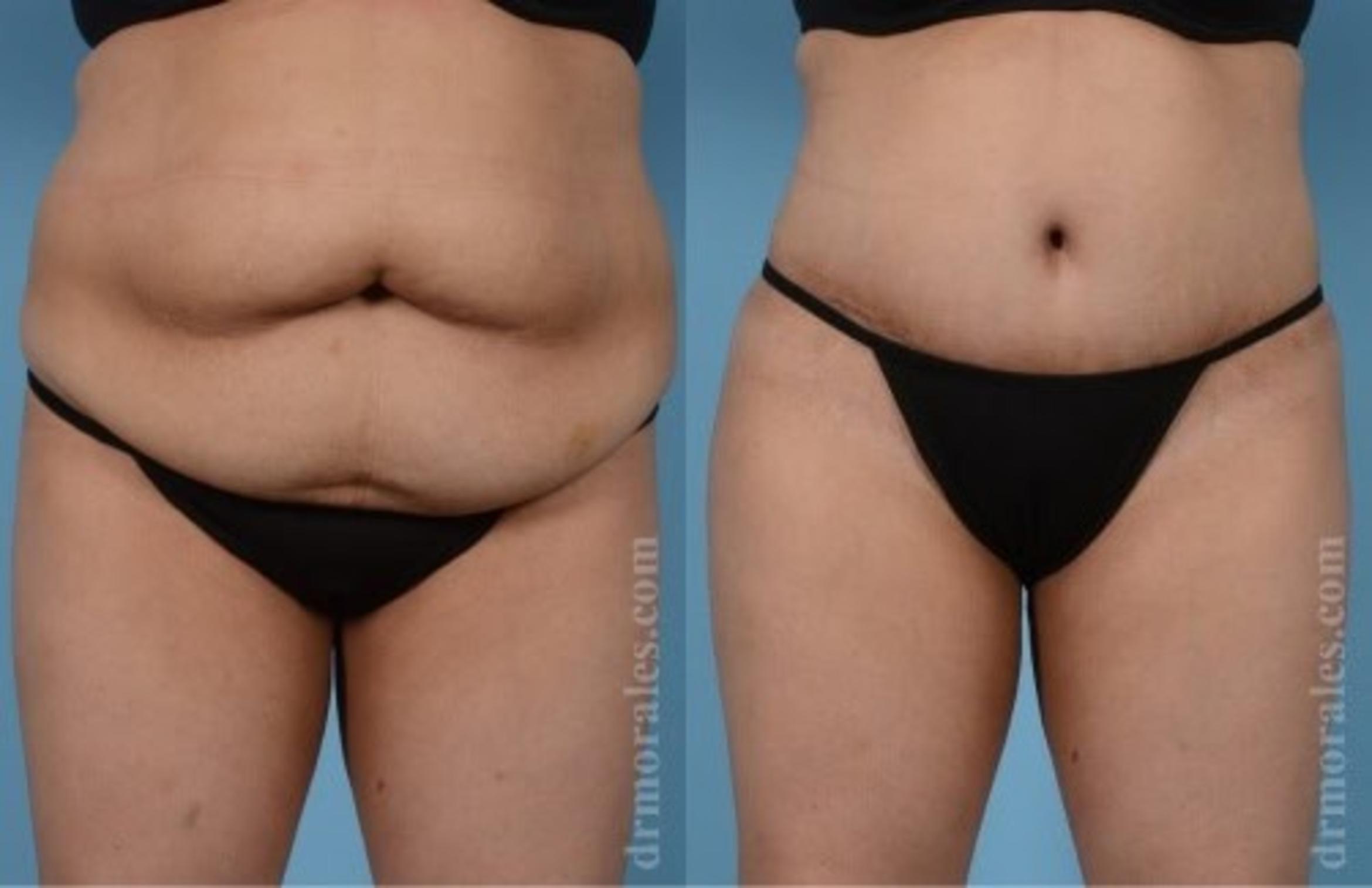 Before & After Tummy Tuck Case 473 View 1 View in Houston, TX