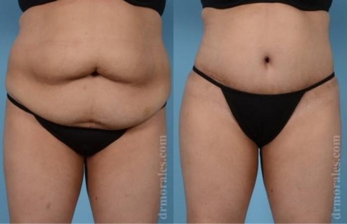 Before & After Tummy Tuck Case 473 View 1 View in Houston, TX