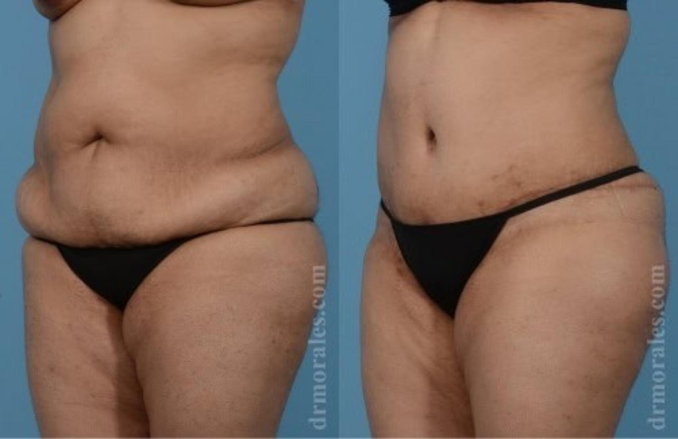 Before & After Tummy Tuck Case 474 View 1 View in Houston, TX