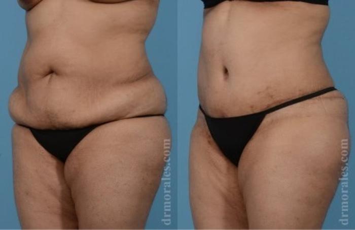 Before & After Tummy Tuck Case 474 View 1 View in Houston, TX