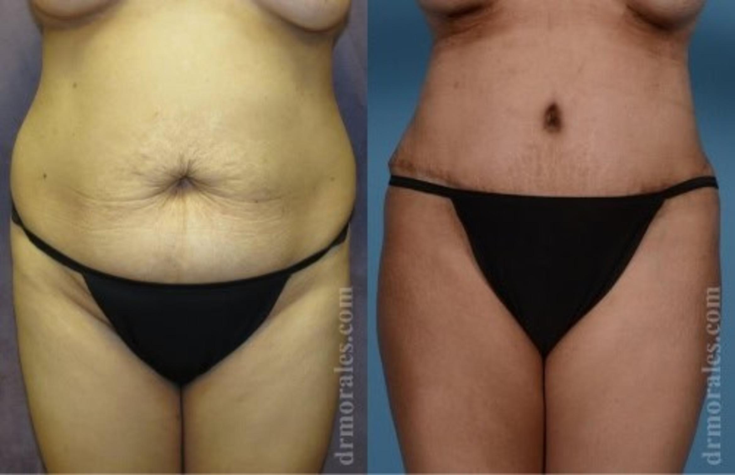 Before & After Tummy Tuck Case 475 View 1 View in Houston, TX