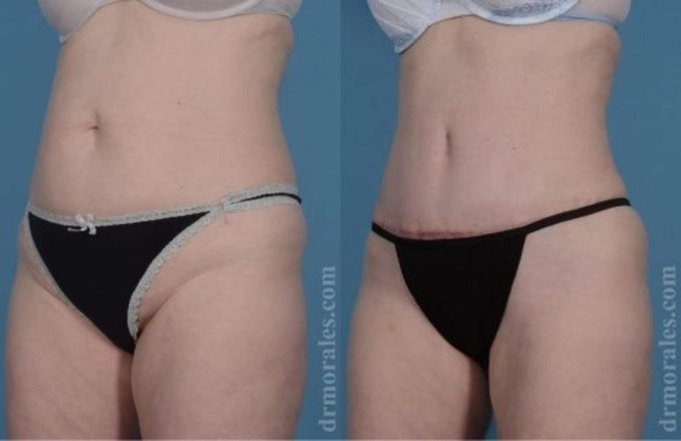 Before & After Tummy Tuck Case 476 View 1 View in Houston, TX