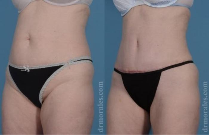 Before & After Tummy Tuck Case 476 View 1 View in Houston, TX