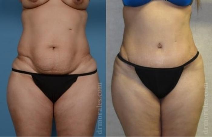 Before & After Tummy Tuck Case 477 View 1 View in Houston, TX