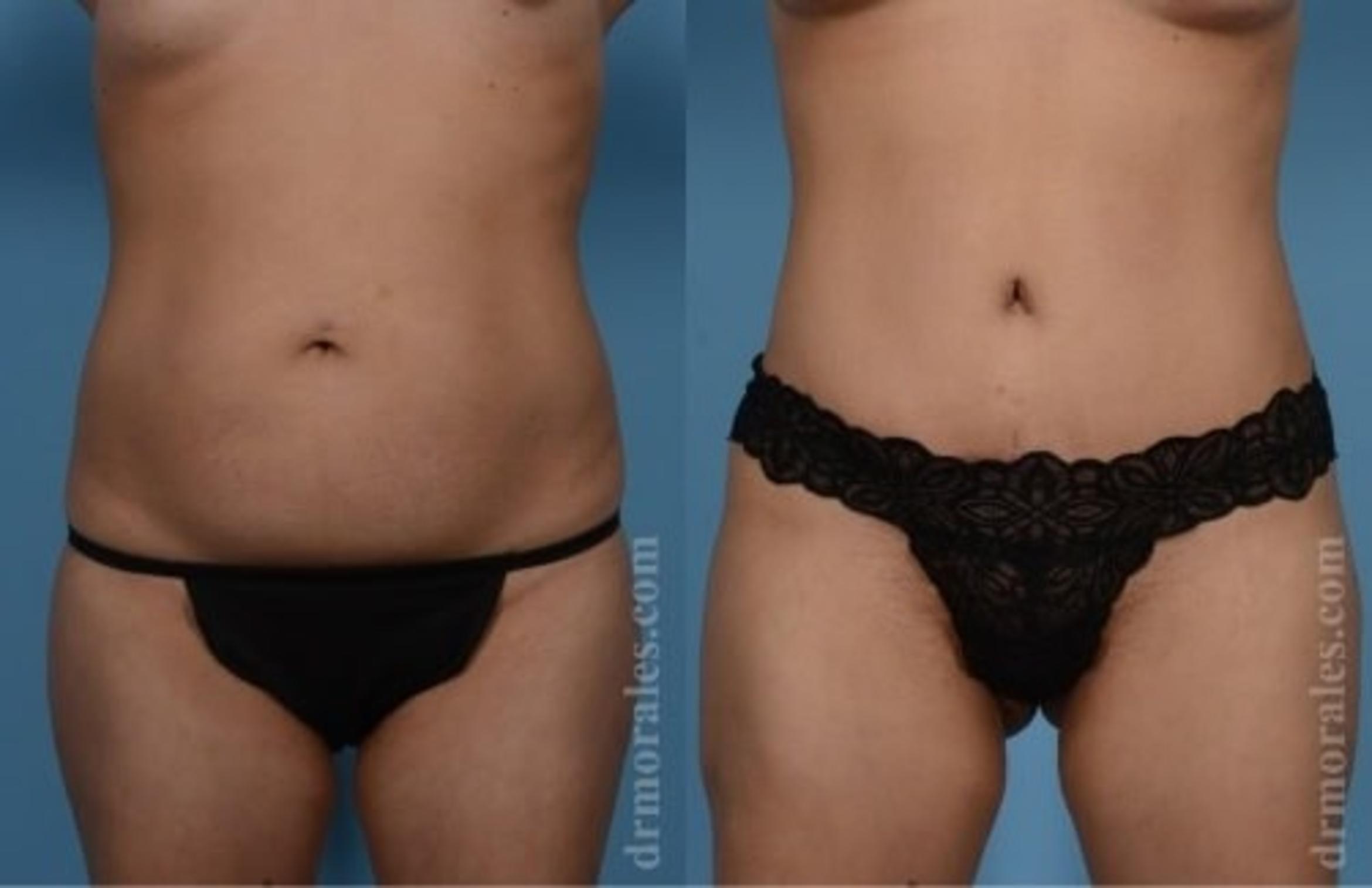 Before & After Tummy Tuck Case 478 View 1 View in Houston, TX