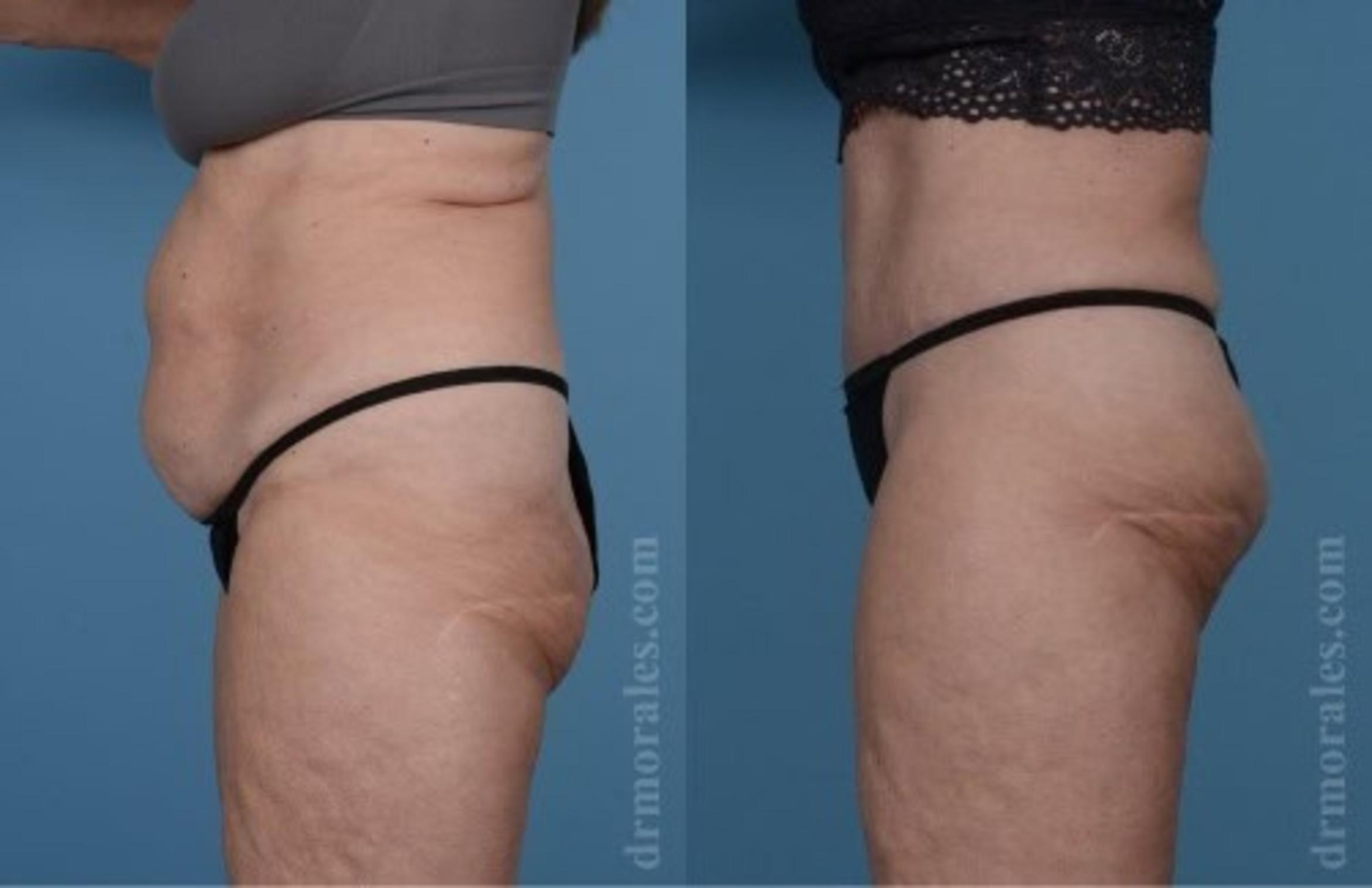 Before & After Tummy Tuck Case 479 View 1 View in Houston, TX