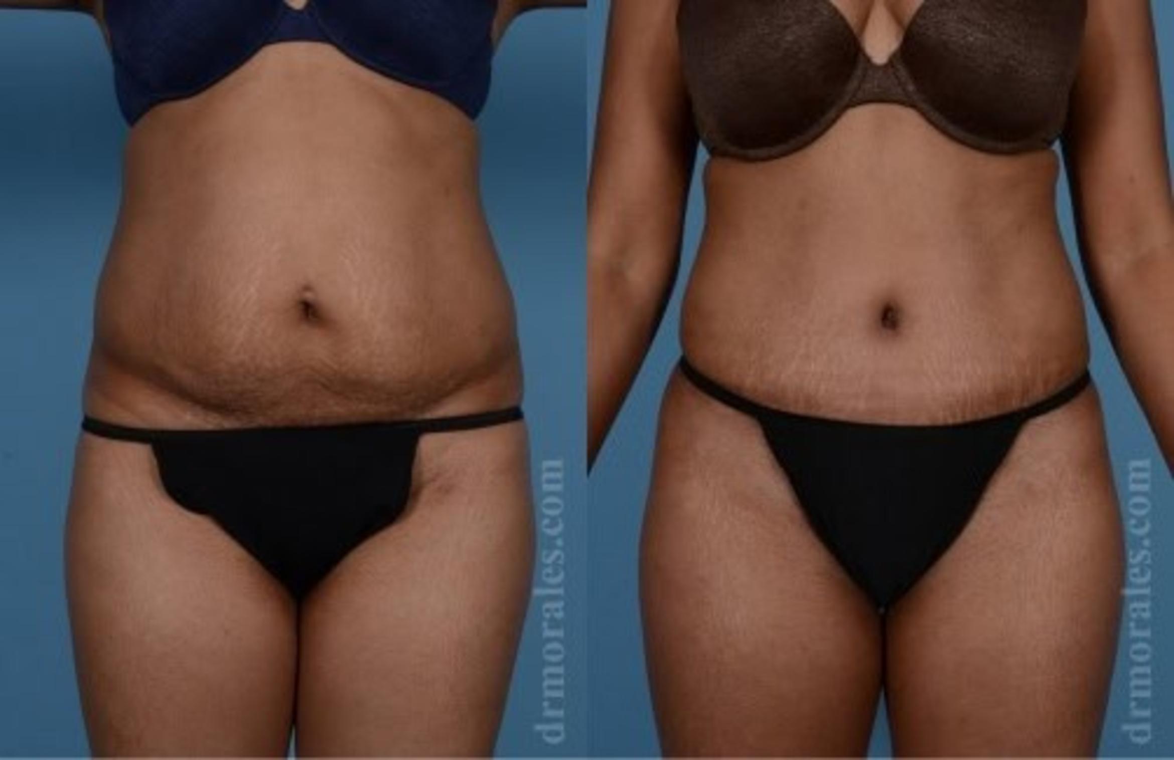 Before & After Tummy Tuck Case 480 View 1 View in Houston, TX