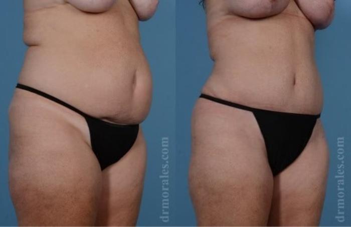 Before & After Tummy Tuck Case 481 View 1 View in Houston, TX