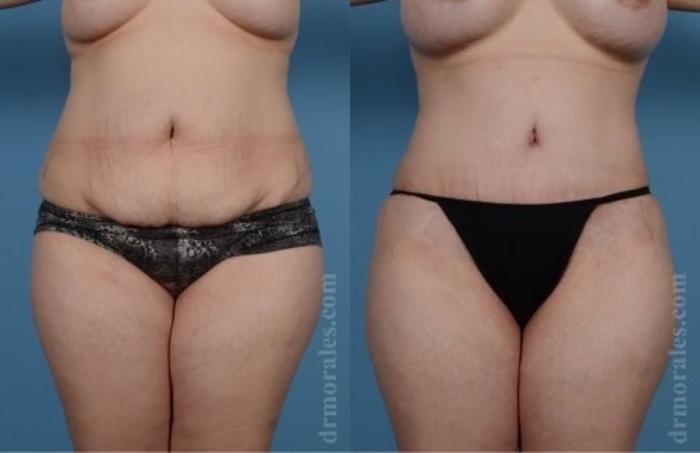 Before & After Tummy Tuck Case 482 View 1 View in Houston, TX