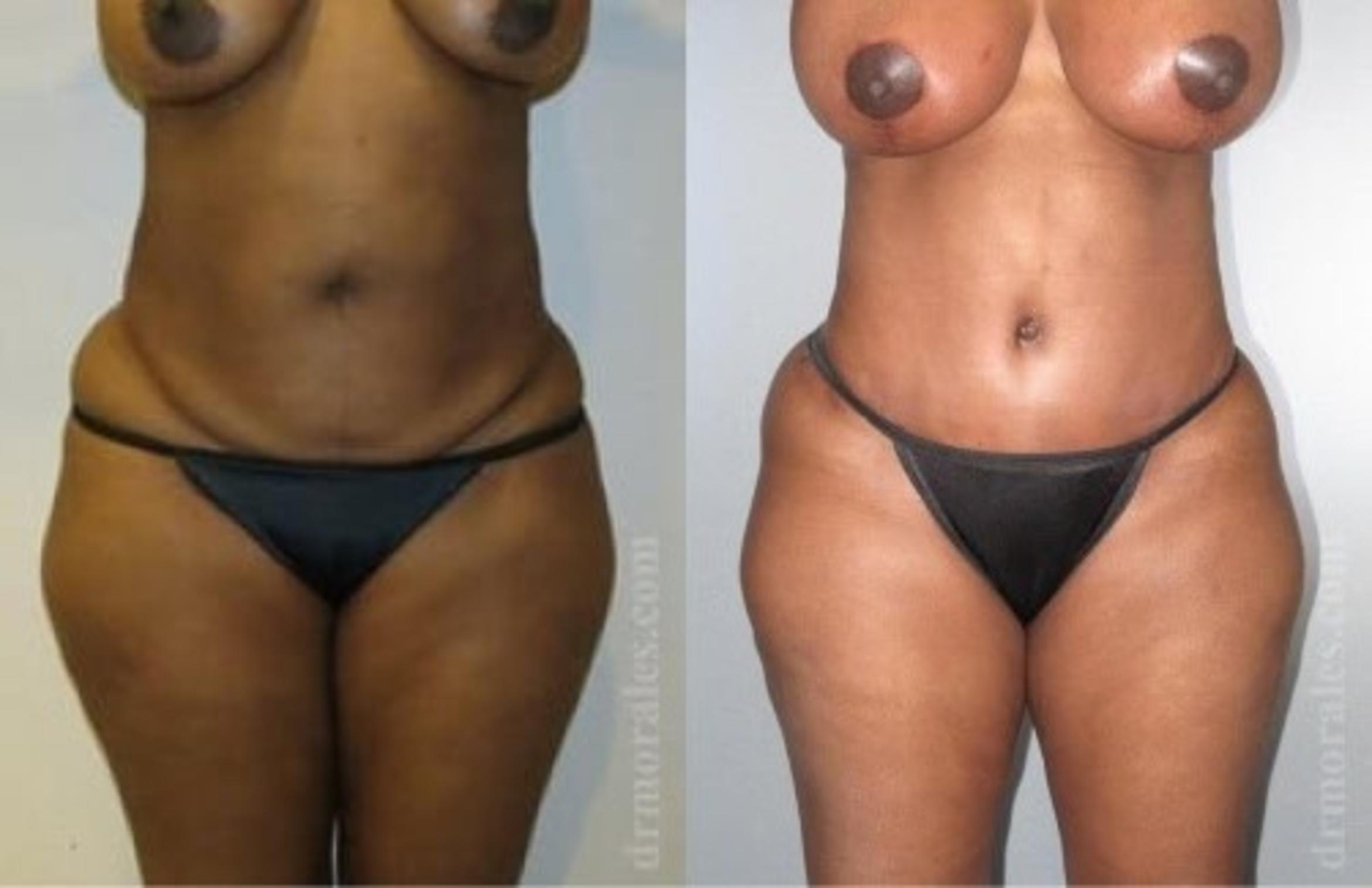 Before & After Tummy Tuck Case 483 View 1 View in Houston, TX