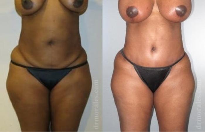 Before & After Tummy Tuck Case 483 View 1 View in Houston, TX